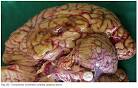 <b>EDEMA</b> CEREBRAL E HIPEREMIA
