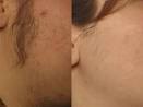  What home hair removal electrolysis really works? hair removal electrolysis 