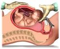 Researchers Link Caesarean Section Birth to Childhood Obesity ...