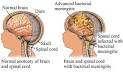 Bacterial Meningitis | SexInfo Online