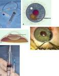 <b>Iris Neoplasms</b>