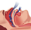 Sleep apnea - Wikipedia, the free encyclopedia