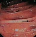 DIVERTICULITIS. Causes, symptoms, treatment DIVERTICULITIS