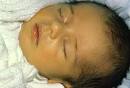 Jaundice