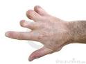 Royalty Free Stock Images: Amputated fingers