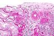 Hyaline <b>arteriolosclerosis</b>