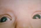 File:Cataracts due to Congenital Rubella Syndrome (CRS) PHIL 4284 ...