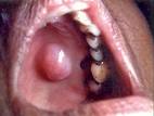 <b>Pleomorphic adenoma</b> Search in