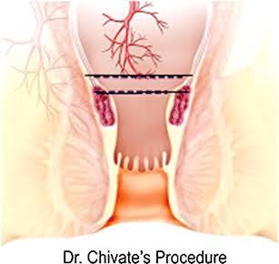 Transanal Suture Rectopexy for Haemorrhoids: Chivate's ...