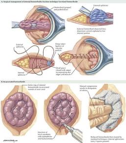 Hemorrhoids and Hemorrhoidectomy | Clinical Gate