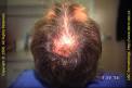 Androgenetic Alopecia