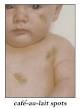About Neurofibromatosis