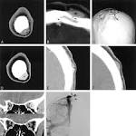 with <b>sinus pericranii</b> and