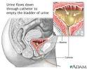 Scripps Health - Acute bilateral <b>obstructive</b> uropathy