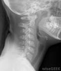 An <b>X</b>-<b>ray</b> of the neck,