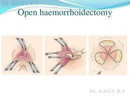 Haemorrhoid Clinic Melbourne | Bayside Colorectal Experts