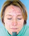  Biocosmetic Center is the First MedSpa in Arizona to Treat Acne With the New Acleara Acne Laser