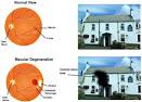 Macular Degeneration?