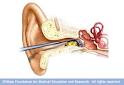 MayoClinic.com Health Library - Earwax blockage