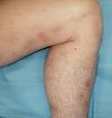 Behçet disease (incomplete) and cutaneous polyarteritis nodosa