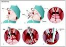 Adenoidectomy - procedure, recovery, blood, removal, pain ...