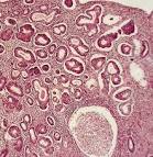 Transvaginal US and Hysterosonography in Postmenopausal Women with ...