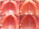 A, <b>denture stomatitis</b> (DS) www.sciencedirect.com