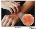 Allergy glossary