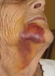 http://www.intelligentdental.com/wp-content/uploads/2011/12/Bruising_from_extraction_of_teeth_1.jpg