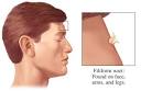 Filiform Warts