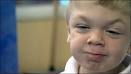 Sindrome di Hurler