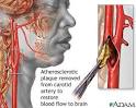 Endarterectomy: MedlinePlus Medical Encyclopedia Image