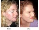  Acne No More Product Review