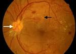 Diabetic Retinopathy   Chapter 29 : Diabetic Complications