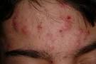  Cystic Acne Medication