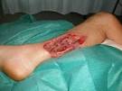 Treatment Flesh-Eating Disease - life choice