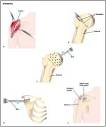 Surgery.com - Arthroplasty Information, Surgery Costs, Surgeons ...