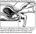 Partial Birth Abortion