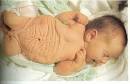 <b>Sindrome de Prune Belly</b>
