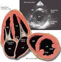 Cardiomyopathy treatment cheaply without transplant