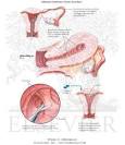 Asherman's Syndrome (Uterine Synechia) - Netter Medical Artwork