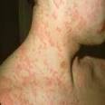 Anaphylaxis | Daft Blogger - Making it accessible