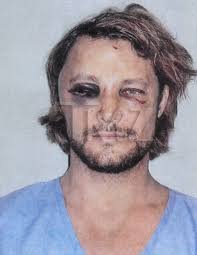 Ok so more pictures of the model dude Gabriel Autry have come out and DAAAAAAAAANG, Olivier whatshisname beat the model out of that dude. Wow! - gabriel-aubry-fight-injuries-06-480w