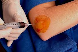  PRP Platelet Rich Plasma Receives Conditional Approval from Medicare for Wound Healing Indication