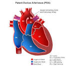 Patent <b>ductus arteriosus</b> is a
