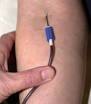 Haemochromatosis