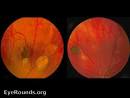 4) <b>Gardner syndrome</b> - multiple