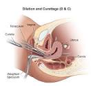 Dilation and Curettage - Thomas Jefferson University Hospitals