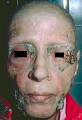 Angiosarcoma