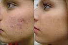  Adult Acne Treatment   Adult Acne Solution